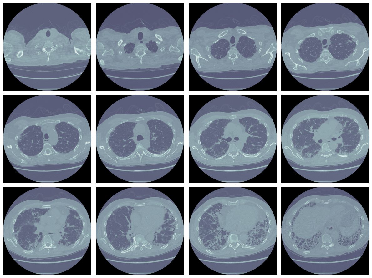 Coupes axiales d'un scanner CT pulmonaire
