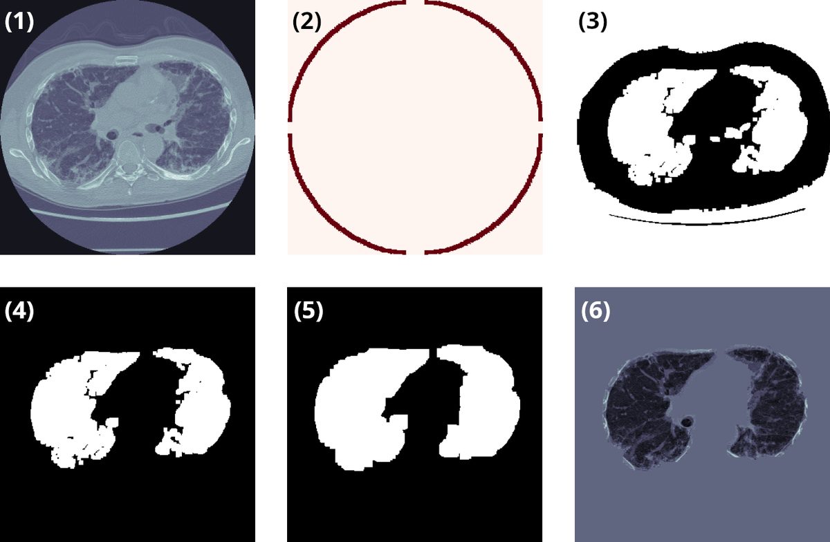 Étapes de la segmentation 3D : (1) Coupe originale ; (2) Frontière externe ; (3) Air brut ; (4) Poumons internes ; (5) Masque final ; (6) Résultat