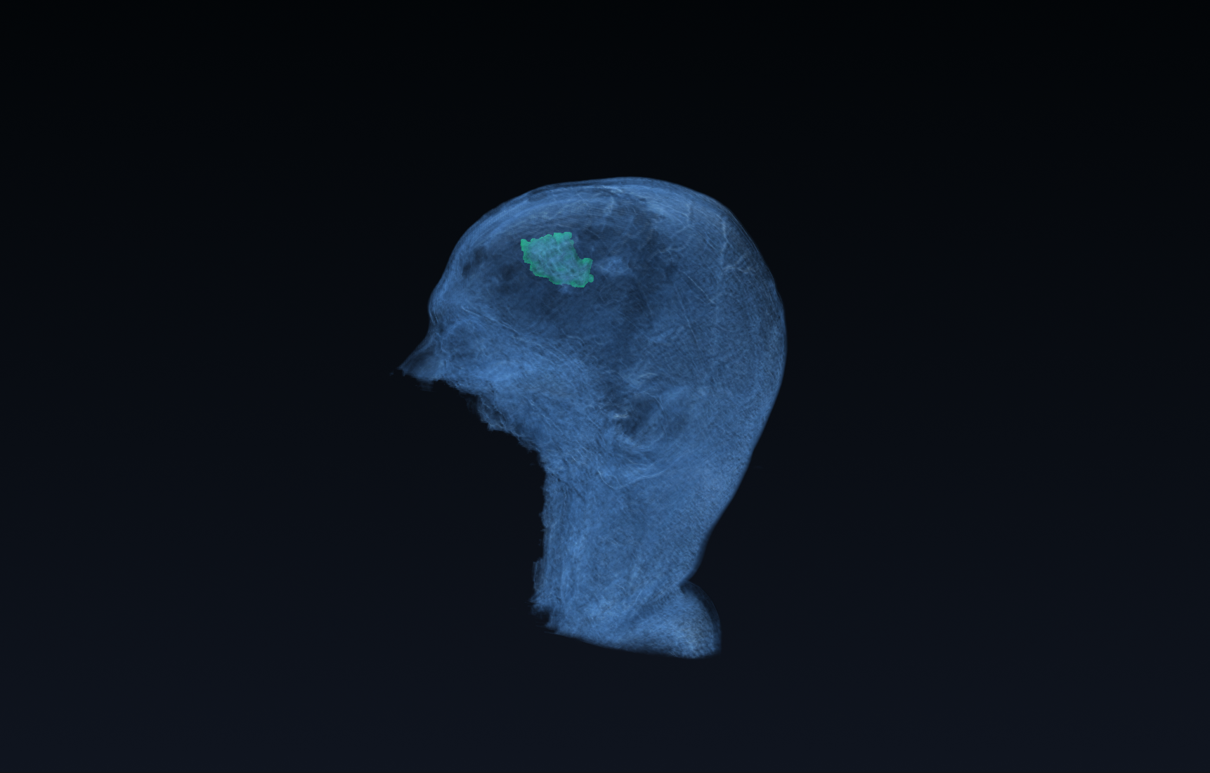 Volumetric brain tumor tracking (VTK/ITK)